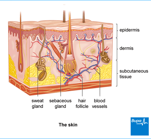 acne vulgaris diagram